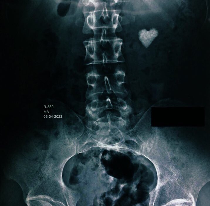 Abdul Wasay Mahmood, MD (@theawmahmood) on Twitter photo I ❤️ Kidney Stones, said no one ever! #heart #shaped #kidney #stone @urosome #urology @MedTwitter <a href="/AmerUrological/">Amer. Urol. Assn.</a> <a href="/Uroweb/">European Association of Urology (EAU)</a> <a href="/renalandurology/">Renal & Urology News</a> <a href="/SIU_urology/">SIU-Urology</a> <a href="/MatchAResident/">Match A Resident®</a> <a href="/UroResidency/">UroResidency</a> <a href="/Inside_TheMatch/">Inside The Match</a> <a href="/UrologyMatch/">Urology Match</a> <a href="/KidneyStonesFix/">Kidney Stones Fix</a> #residency <a href="/UnmatchedMD/">The Unmatched MD</a> <a href="/JUrology/">Journal of Urology</a> I ❤️ Kidney Stones, said no one ever! #heart #shaped #kidney #stone @urosome #urology @MedTwitter <a href="/AmerUrological/">Amer. Urol. Assn.</a> <a href="/Uroweb/">European Association of Urology (EAU)</a> <a href="/renalandurology/">Renal & Urology News</a> <a href="/SIU_urology/">SIU-Urology</a> <a href="/MatchAResident/">Match A Resident®</a> <a href="/UroResidency/">UroResidency</a> <a href="/Inside_TheMatch/">Inside The Match</a> <a href="/UrologyMatch/">Urology Match</a> <a href="/KidneyStonesFix/">Kidney Stones Fix</a> #residency <a href="/UnmatchedMD/">The Unmatched MD</a> <a href="/JUrology/">Journal of Urology</a>