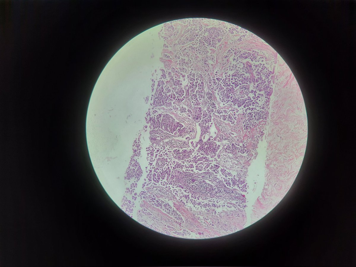 pathognosis22's tweet image. #Case5 case of IDCNST only #PathTwitter #Histopath #pathtwitter #histology #PathArt #pathology