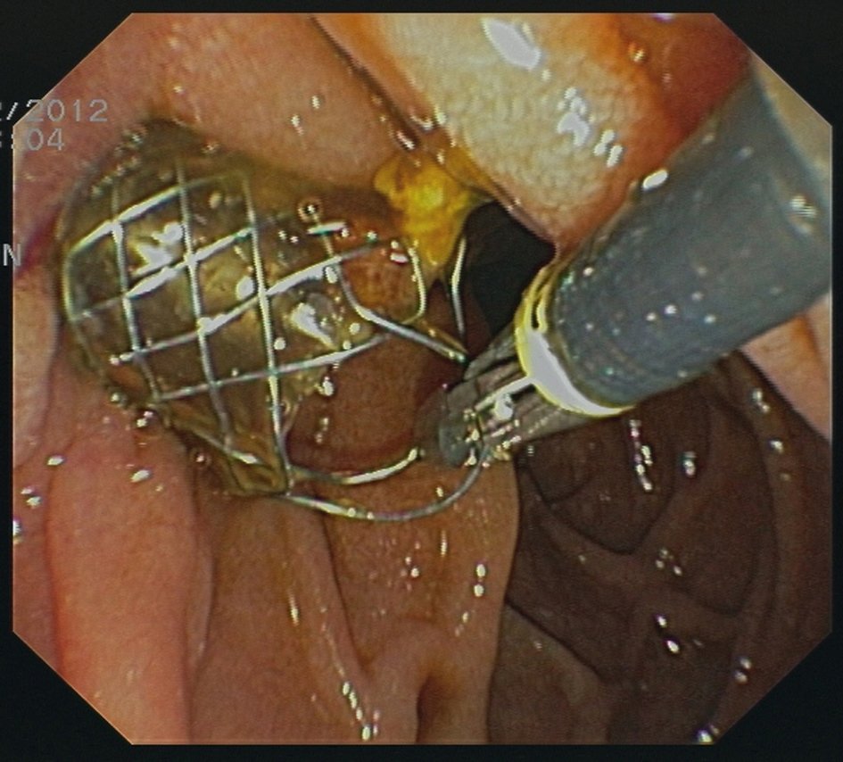 criley_md's tweet photo. Plastic vs metal stents for malignant biliary obstruction? 🤔
#gitwitter #endobiliary #hepatobiliary #GIintervention https://t.co/rLh9k0VRQO