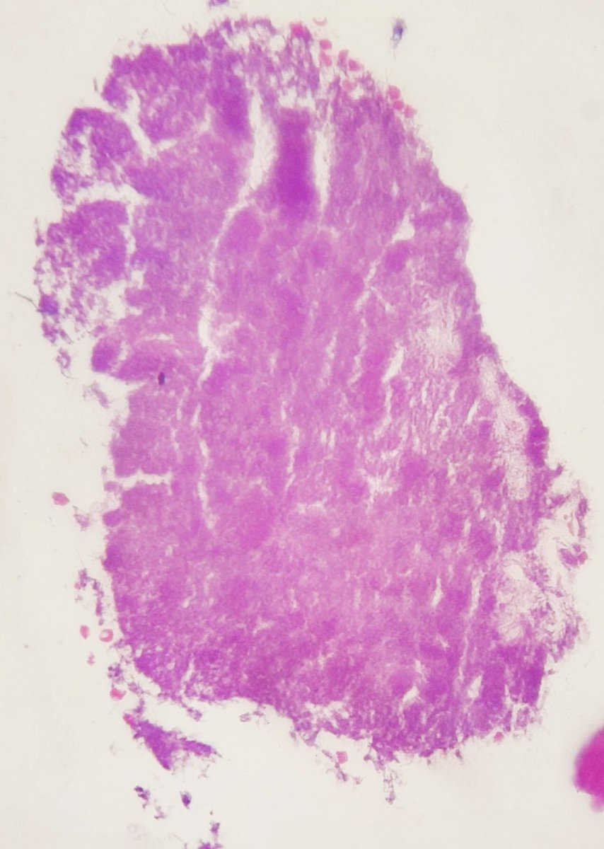 pathognosis22's tweet image. #Case6 Actinomyces , PAS+,SM+, (Gram +), AFB -
