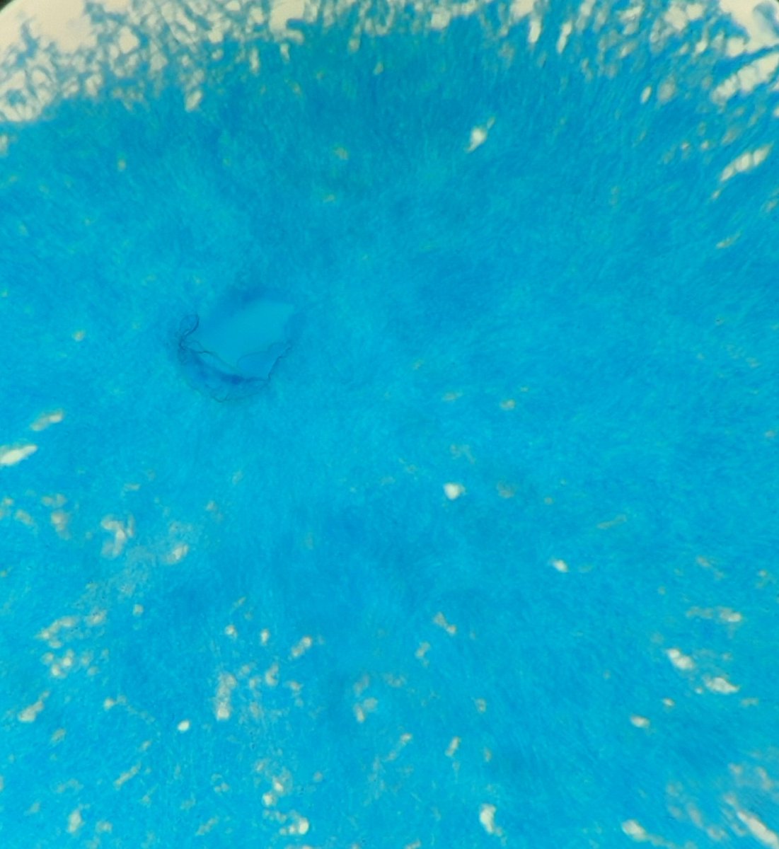 pathognosis22's tweet image. #Case6 Actinomyces , PAS+,SM+, (Gram +), AFB -