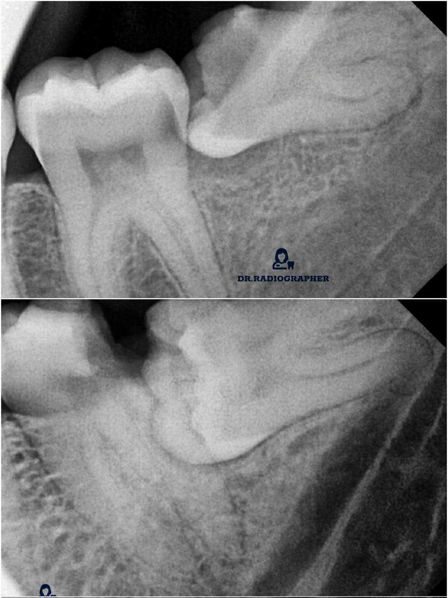 Classic case when it is said Dentistry is not expensive but neglect is. 
In first pic one tooth can be saved.
In other both go out of your mouth. 
#dentistryfacts #dentalcare