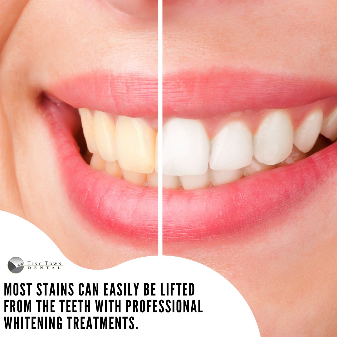 Most stains can easily be lifted from the teeth with professional whitening treatments. Schedule your teeth whitening today! 
#tinytowndentist #tinytowndental #oralhealth #dentist #FamilyDentist #Whitening