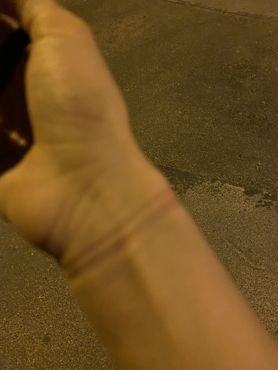 Yolda yürüyorum birden parmaklarımda uyuşukluk hissettim. İçimden de diyorum tansiyonum falan mı düşüyo noluyo, meğer kangren oluyomuşum amk