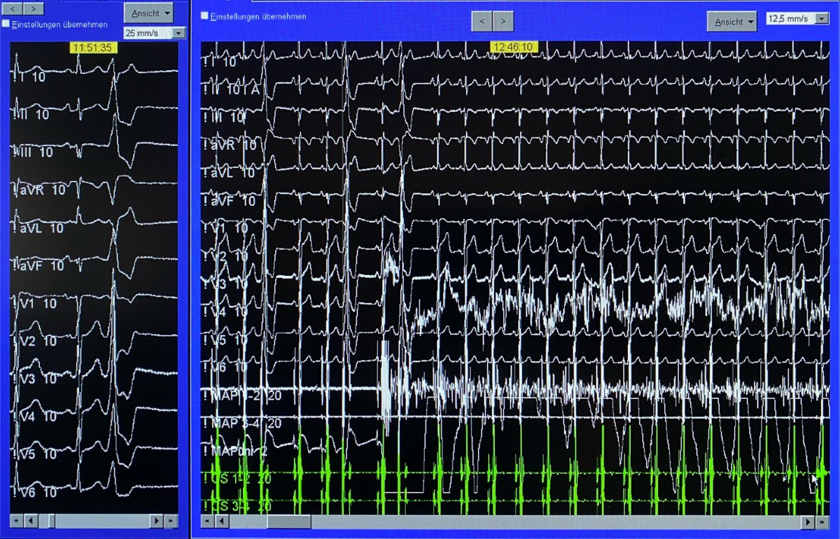 ShaojieChen1's tweet photo. Hi #EPeeps #ECG have you met
“brother PVCs from two brothers” ?😃

full of interesting clinical cases for another week...

Live from another BOX🤨
#ablatevt #ablatepvc #ccbfrankfurt #CardioTwitter https://t.co/HBptOAjP1Y