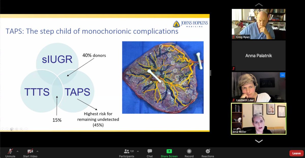 Did you know that TAPS is a complication that has the highest risk of being undetectable in monochorionic gestations?