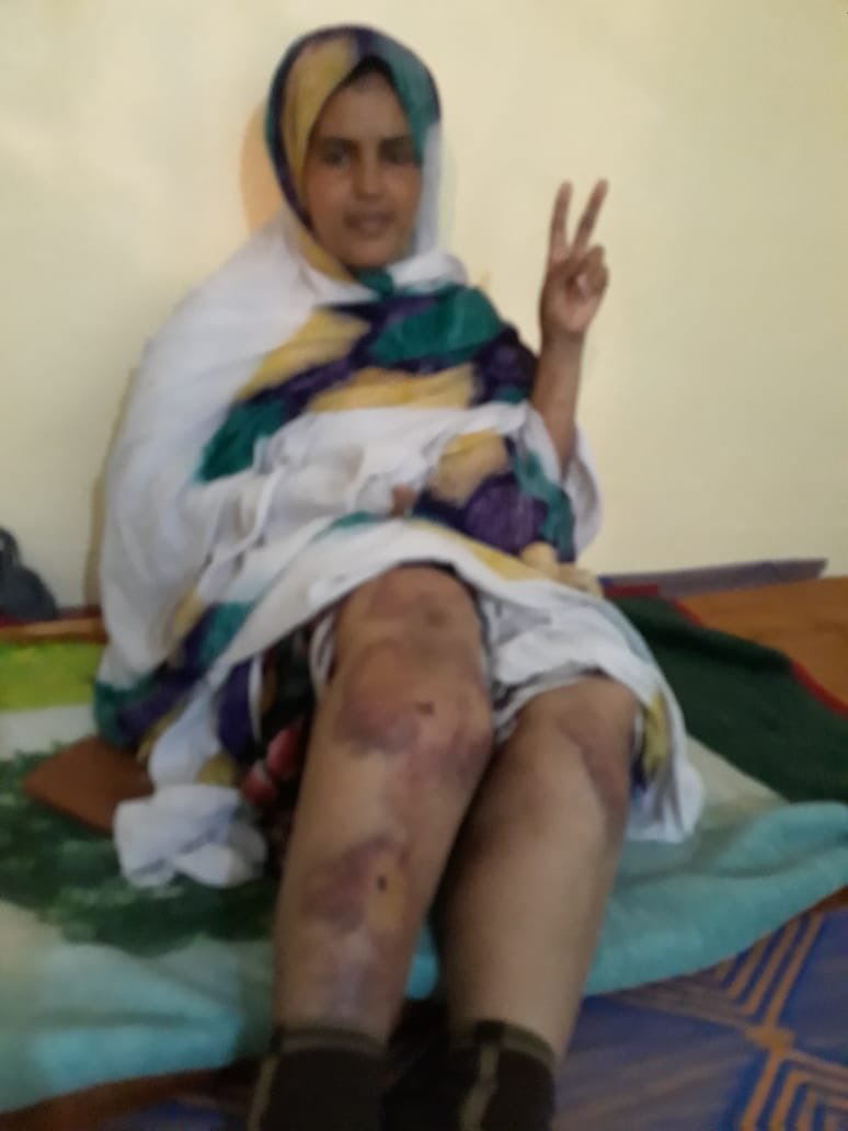 It is how our bodies look like in #WesternSahara all time when we decide to ask for freedom and dignity.Fatma Elhafidi is a human rights defender who was tortured by Moroccan forces,7 Police officers with civilian clothing tortured one women in occupied Boujdor until she fainted