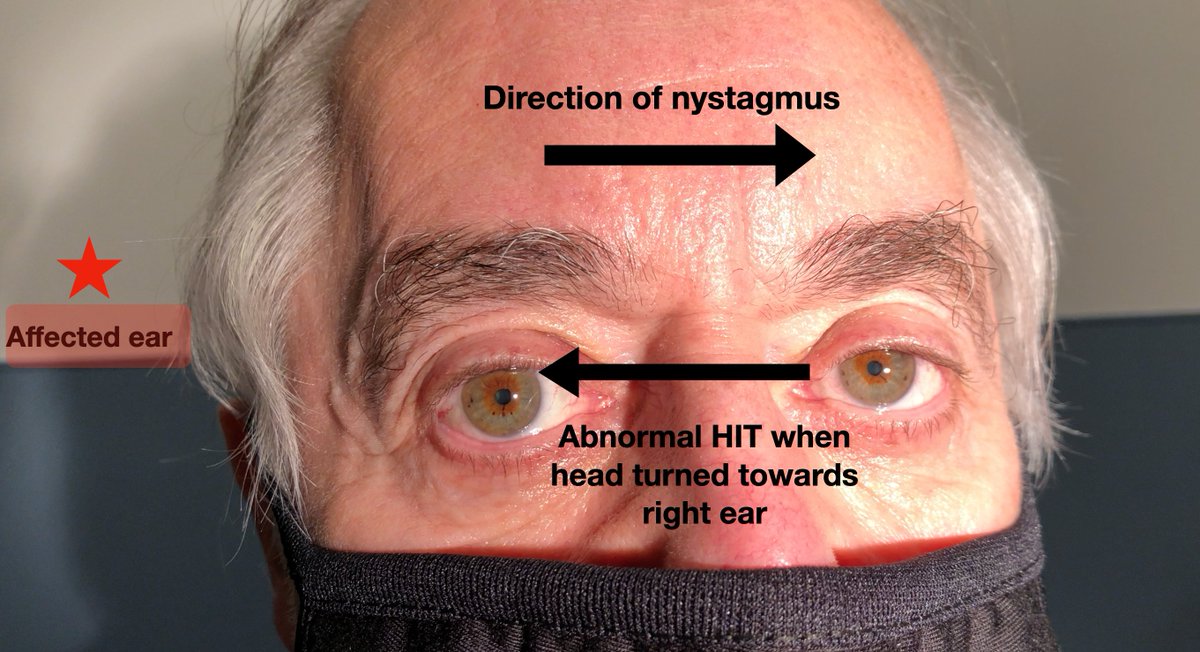 PeterJohns84's tweet photo. Are you confused about which ear the nystagmus in vestibular neuritis beat?  This video will set you straight!
#FOAMed  #Neurology #emergencymedicine https://t.co/2byjAFsnAC https://t.co/hjbgyx4rVN