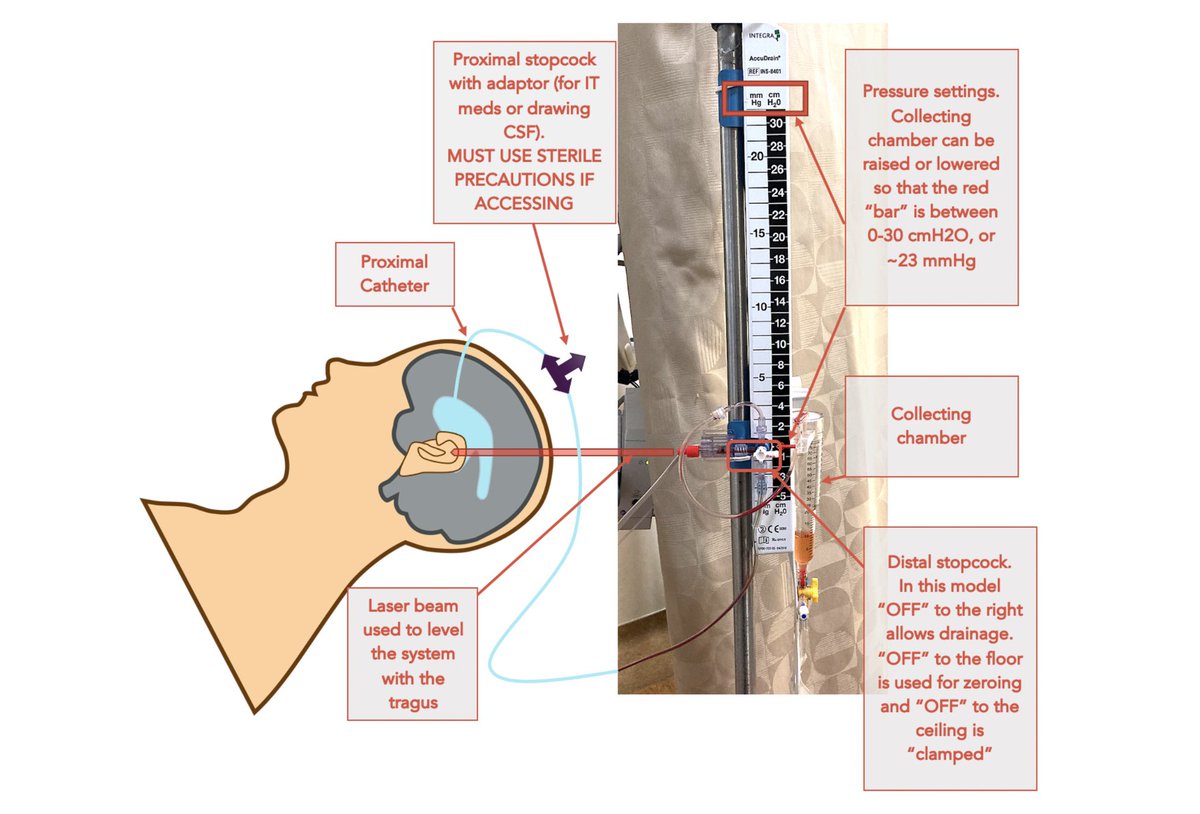 srrezaie's tweet photo. EVD BASICS:

Laser Beam —> Level w/ tragus
Prox Stop Cock —> Clearance of blood products/infection
Collecting Chamber —> Up or down to set desired pressure
Distal Stop Cock —>
-“Off” to right - Allows Drainage
-“Off” to floor - Zeroing
-“Off” to ceiling - Clamped

#FOAMed #FOAMcc https://t.co/sNW8i8Ai4X