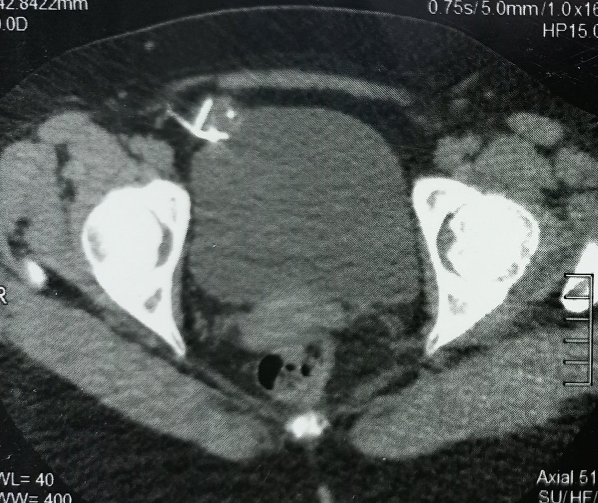 Another case of Migrated IUCD 
This time to anterior bladder wall
38 y, 2 CS, presented with recurrent UTI and haematuria
