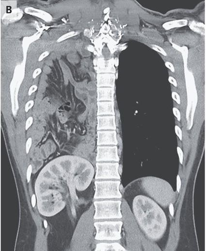 AvrahamCooperMD's tweet photo. Yes that is indeed the omentum, intestines and right kidney occupying the right chest (congenital diaphragmatic hernia)

#MedTwitter https://t.co/yEJsozmIcP