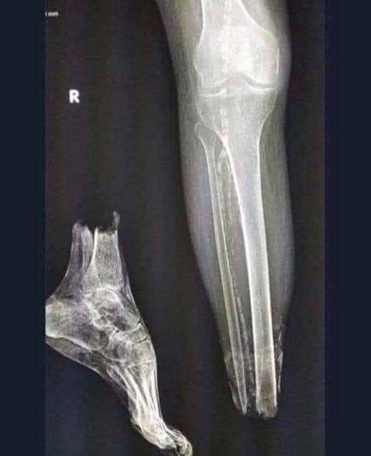 por andar descalzo