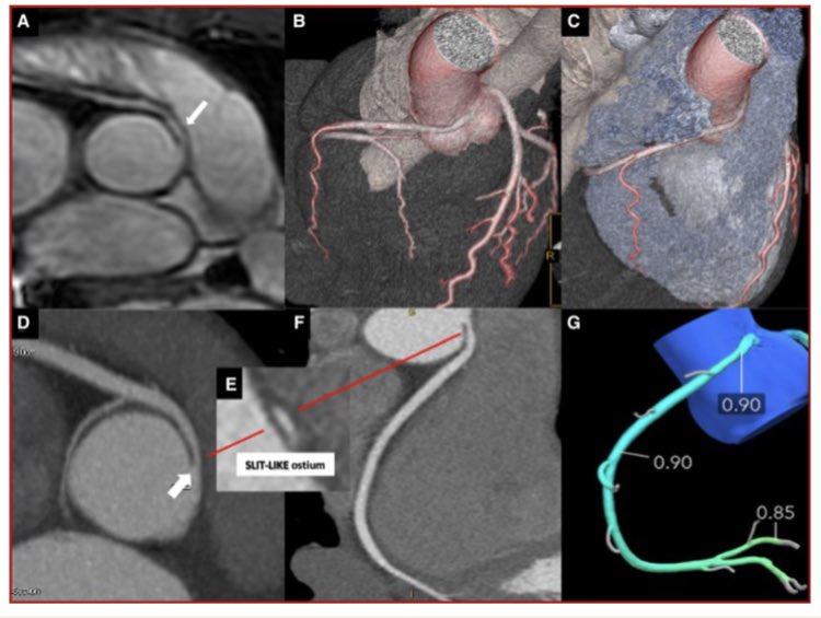 denisamuraru's tweet image. Beautiful review on the value of #WhyCCT in #sport cardiology in #EHJCVI by @FlavioDascenzi @gpontone1 @Matte_Cameli @DrGEMandoli @AndreBaggi

doi.org/10.1093/ehjci/…

@ESC_Journals @GeraldMaurer @EACVIPresident