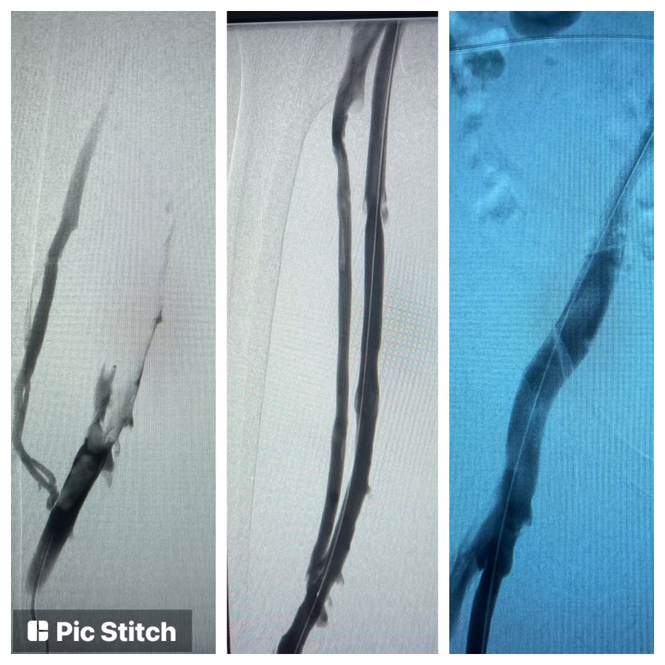 amitviraMD's tweet photo. Finally got my chance to play with this amazing system! ⬇️ 27M w extensive L ileo-fem DVT. 6 passes w @InariMedical ClotTriever with acute thrombus removed. Excellent results! Thanks to Dr. Tucciarone for the guidance on this case! @BeaumontIC @BeaumontCards @BeaumontHealth-Troy https://t.co/3dGWVGFIpF