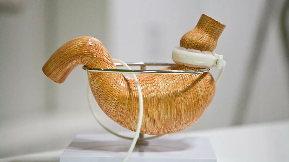 Severely obese patients slated for total knee replacement had generally better outcomes when they lost substantial weight beforehand through bariatric surgery, compared with usual treatment in a randomized trial.

buff.ly/3xFu4IT