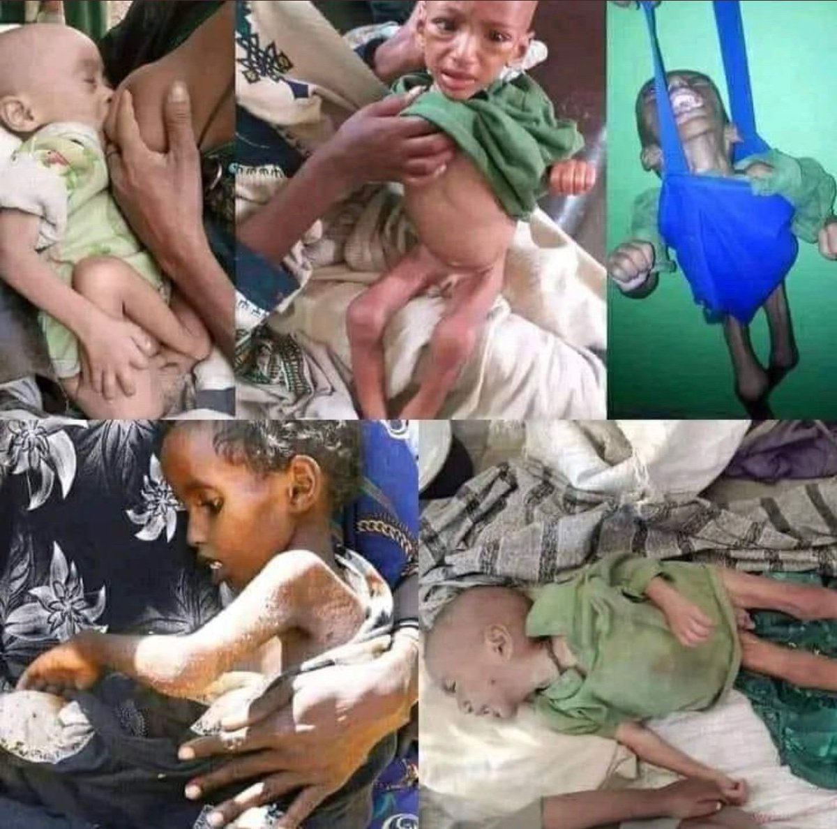 Shalomzon's tweet photo. We've seen pictures of emaciated children, who are the "lucky ones" to escape #TPLF's clutches but they need immediate medical attention. Millions of innocent civilians in #Amhara &amp; #Afar Regions have been under siege by TPLF for 8+ months @WFPChief @StateDeptSpox @SenateForeign https://t.co/sGTqplSdbn