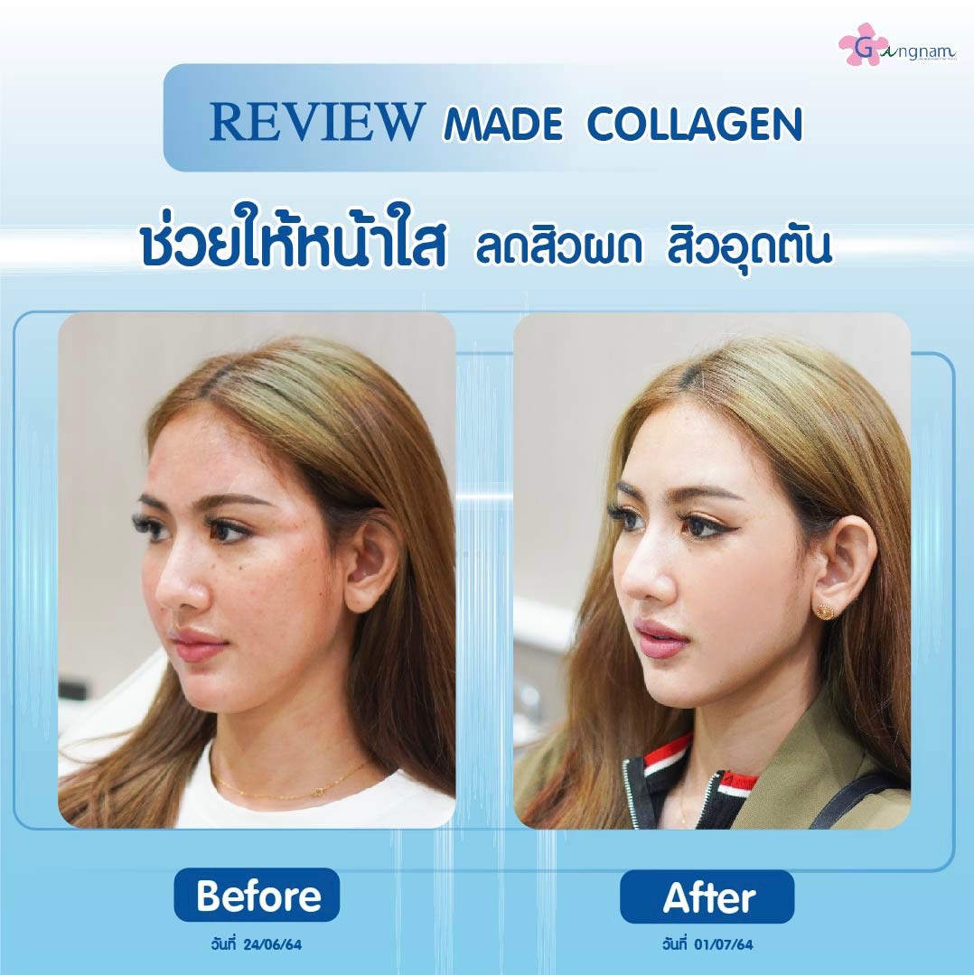 GangnamclinicT's tweet photo. ใครๆ ฉีดแล้วก็ว้าว กับผลลัพธ์ ของทางลัดการดูแลผิว
เคลียปัญหาสิว ให้ผิวดูใสด้วย  Made Collagen 💖 

สนใจ - สอบถามออนนี่ ที่ Line ID :@gangnamclinic

 #มาเด้คอลลาเจน #MadeCollagen 
#กังนัมคลินิก #Gangnamclinic https://t.co/3chHgYSoBi