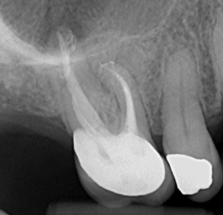 2-visit reRCT UR6 - insane apical delta anatomy P and MB canals - all thanks to the power of hypochlorite!🤣
Edge Endo preps VC obturation #savingteeth #endodontics