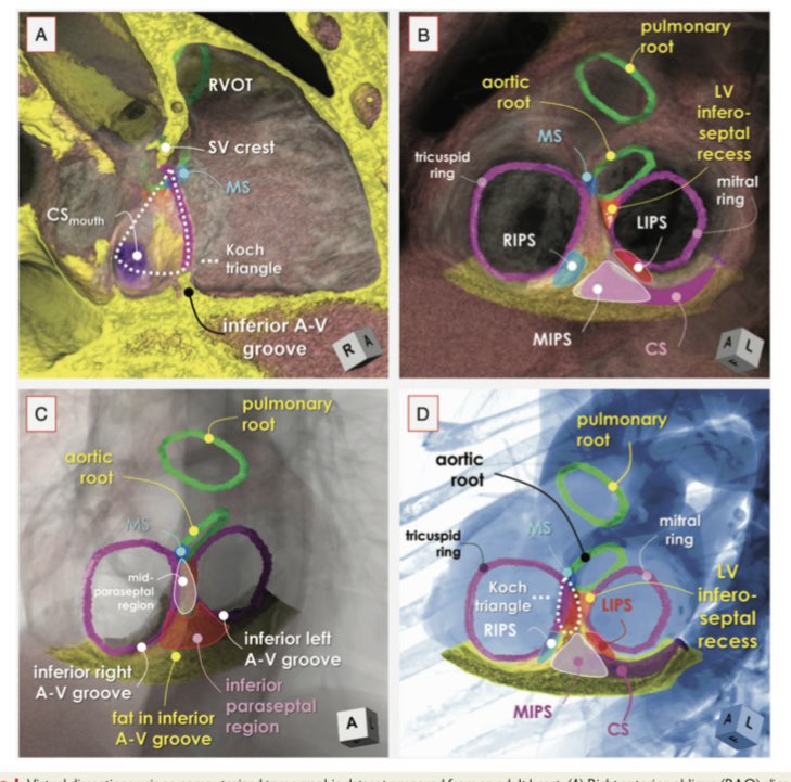 jacabreracardio's tweet image. 👩‍🎓👨‍🎓electrophysiologists performing accessory pathway ablation have used the term &apos;posteroseptal&apos; region . 🔹This area, however, is neither septal nor posterior, but paraseptal and inferior. 
EP Europace, Volume 24, Issue 4, April 2022, Pages 676–690, doi.org/10.1093/europa…