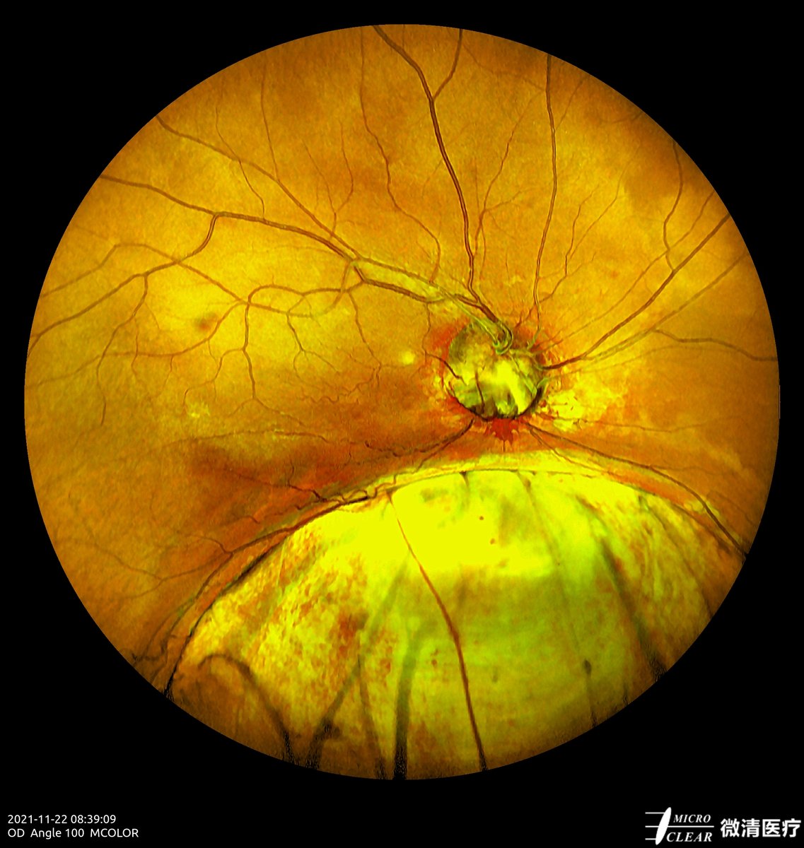 Choroidal Defect
Pictured by Apollo, the #ConfocalRetinalOphthalmoscope
#autofluorescence #fluorescenceangiography #funduscamera #retinaldiseases #Oct #laserscanning