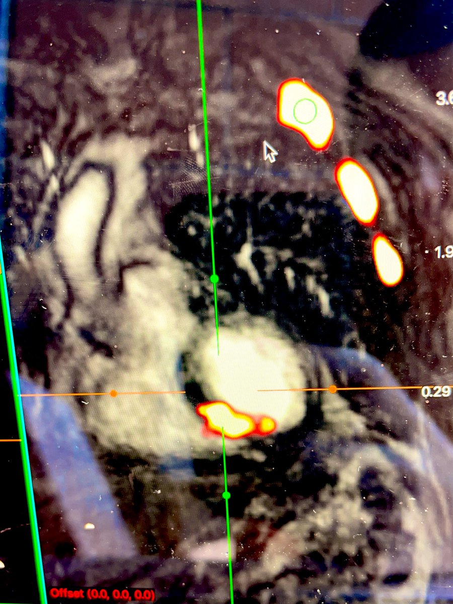 Unbelievably it’s a year today since our first FAPI PETMR scan! To say the time has flown is an understatement. Nothing in life or research is without challenges but I’m so proud of what’s been achieved in 12 months and grateful for all the support I’ve received 1/2