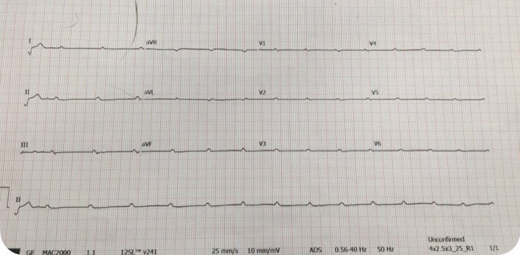 After years of moaning about never being provided with a 12-lead of the presenting arrhythmia…. #eppeeps @dr_pmueller @narrowQRS @jeffrey_vinocur best device choice….? Anything, but quickly was my approach!!
