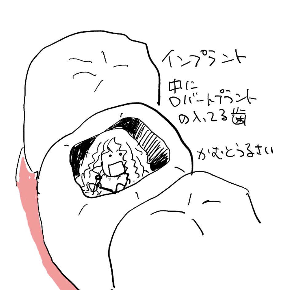 インプラント 