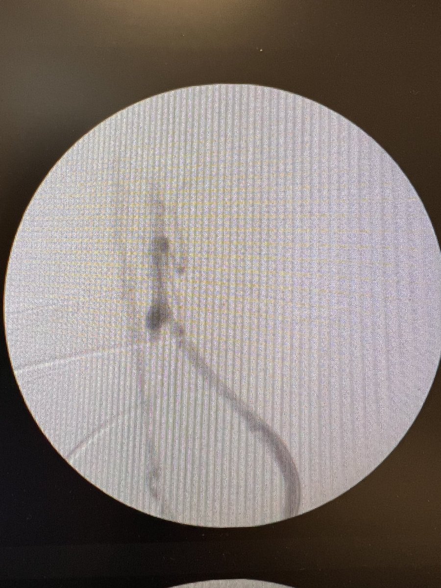 JHakmei's tweet photo. Happened during a Thrombectomy. Story in four pics! @ASDINNews @askrenal https://t.co/8NJdD66EY1