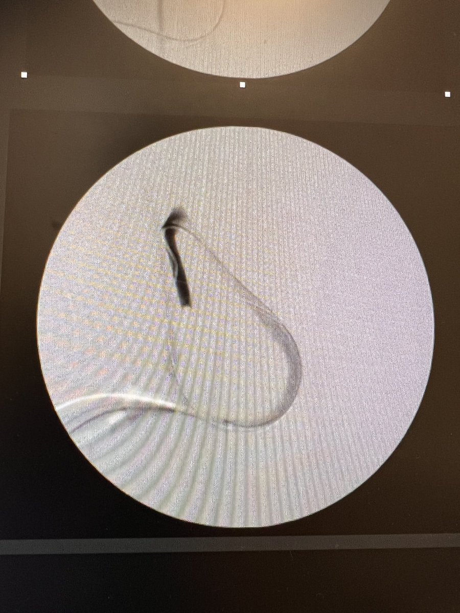 JHakmei's tweet photo. Happened during a Thrombectomy. Story in four pics! @ASDINNews @askrenal https://t.co/8NJdD66EY1