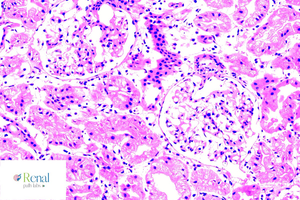 RenalPathLabs's tweet photo. Many a times morphology is so clear that wait for IHC is just a formal process in transplant pathology & u can connect to ur Nephrologist to tell him what u think.
1. Identify it Nephrology & Pathology PGs ! 2. If IF is not C4d, what can it be?
#RenalPathLabs #Askrenal #ISRTP https://t.co/faE035a24d