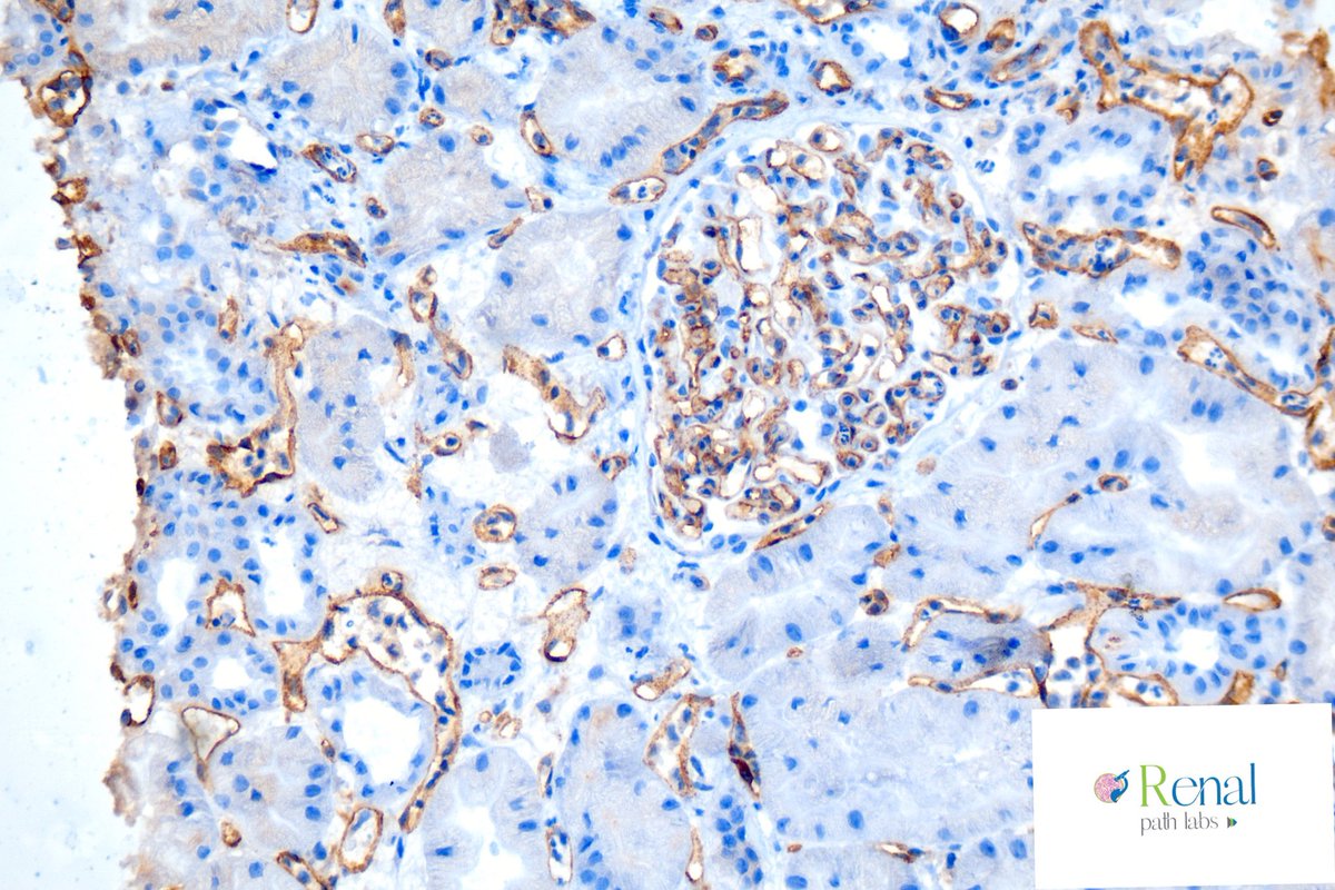 RenalPathLabs's tweet photo. Many a times morphology is so clear that wait for IHC is just a formal process in transplant pathology & u can connect to ur Nephrologist to tell him what u think.
1. Identify it Nephrology & Pathology PGs ! 2. If IF is not C4d, what can it be?
#RenalPathLabs #Askrenal #ISRTP https://t.co/faE035a24d