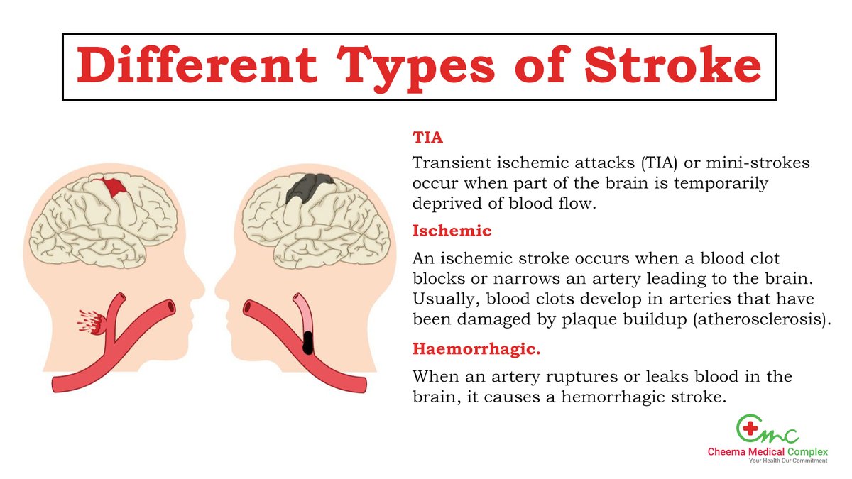 CMCmohali's tweet photo. There are three major types of #strokes that occur.
Remember to reach out to us if you or someone you know is showing #symptoms of a possible stroke.
For the best treatment, visit #CheemaMedicalComplex, Mohali. For Enquiry, call us on 0172-4008070, 8054922340, 9876405771. https://t.co/o0uk30FmbQ