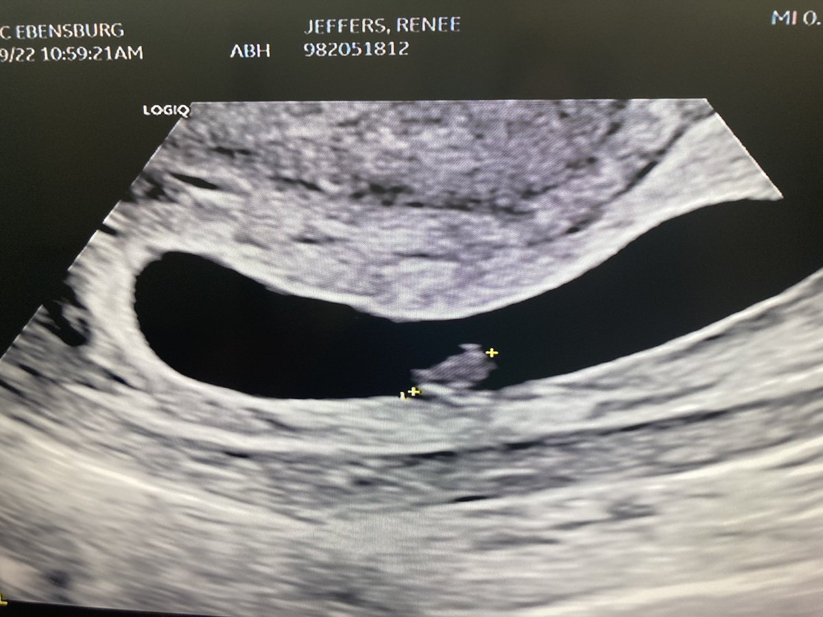 Renee_jaaay's tweet photo. Seeing the flutter of your baby’s heart is one the most incredible feelings in the world.🤰♥️ https://t.co/LhT1LAoywY