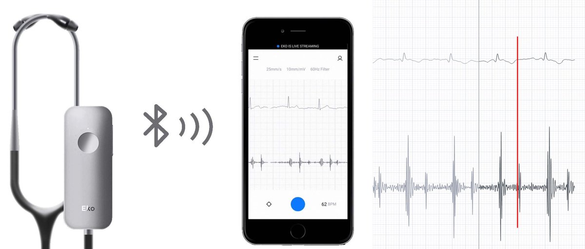 Ugur Kucuk (@ugurkucuk) on Twitter photo Amazing review on electromechanical reciprocity in LQTS. I have <a href="/Eko_Health/">Eko Health</a> Duo stethoscope. I always check electromechanical window via my stethoscope if QT is long. #digitalhealth #EPeeps Amazing review on electromechanical reciprocity in LQTS. I have <a href="/Eko_Health/">Eko Health</a> Duo stethoscope. I always check electromechanical window via my stethoscope if QT is long. #digitalhealth #EPeeps