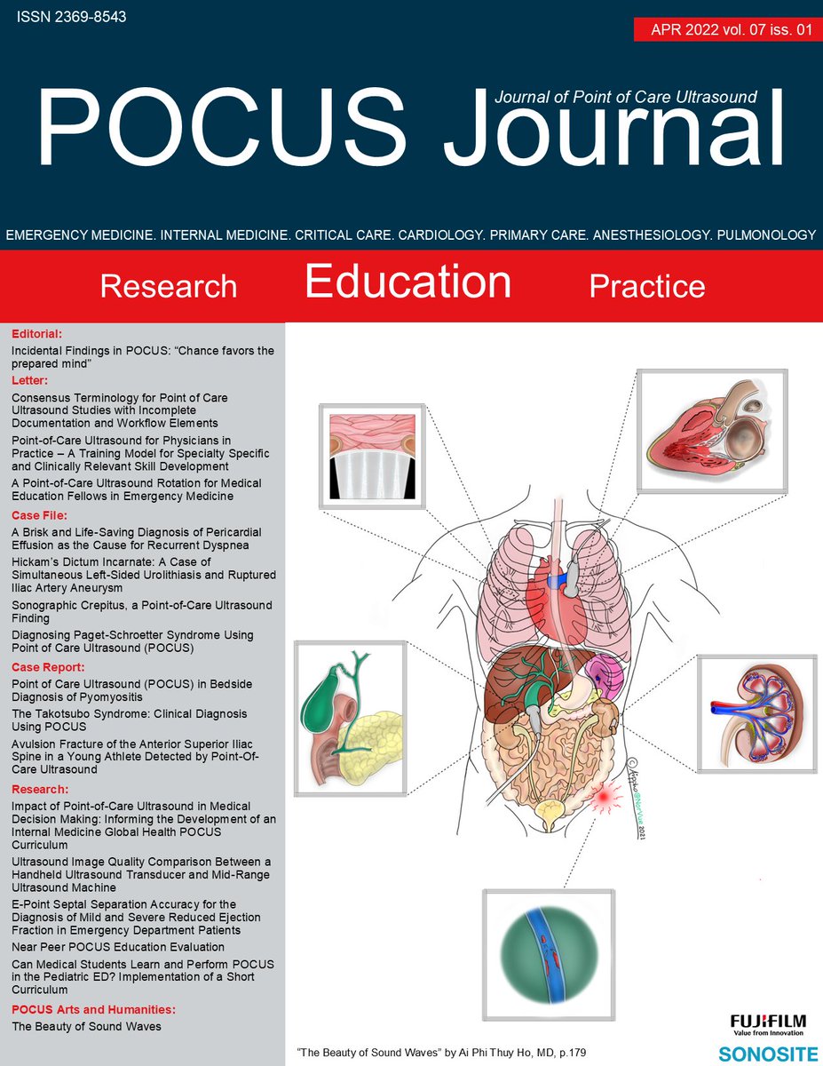 POCUS Journal Vol 7 Iss 01 is now available online! Read it here: pocusjournal.com/issue/vol-07-i… #POCUSJournal #POCUS #FOAMed #FOAMus #MedEd