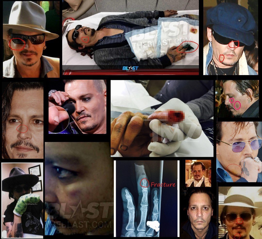 StardustNova27's tweet photo. Johnny Depp has photos of black eyes, welts, bruises, cigarette burns, lost part of his finger, audio of Amber Heard screaming abuse and admissions that she hit him. 

Amber Heard has old, private texts from 2013.

#JohnnyDeppIsInnocent 
#JusticeForJohnnyDepp #DeppvHeard https://t.co/9t6fx9Tu8O