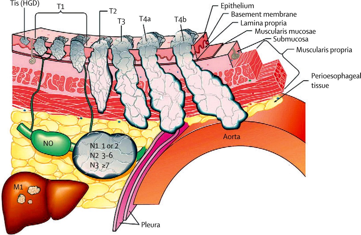 TNM staging of oesophageal cancer #4KMedEd #GITwitter 

thelancet.com/journals/lance…