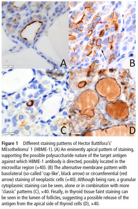 JClinPath_BMJ's tweet photo. 👇 #Review just published!
"Lights on #HBME-1: the elusive biomarker in #thyroid cancer #pathology" 🔬
by @VLimperioMD @FabioPagni1 @NicolaFuscoMD @DSeminatiMD
#ENTpath #thyroidpath https://t.co/qxbfWAuug0