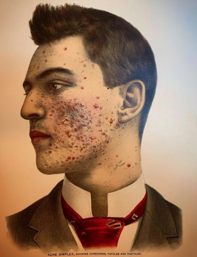 jatustein's tweet photo. #Illustration
#unknownartist
#medicalillustration
#acnesimplex #comedones #papules #pustules https://t.co/VsPt15rwA0