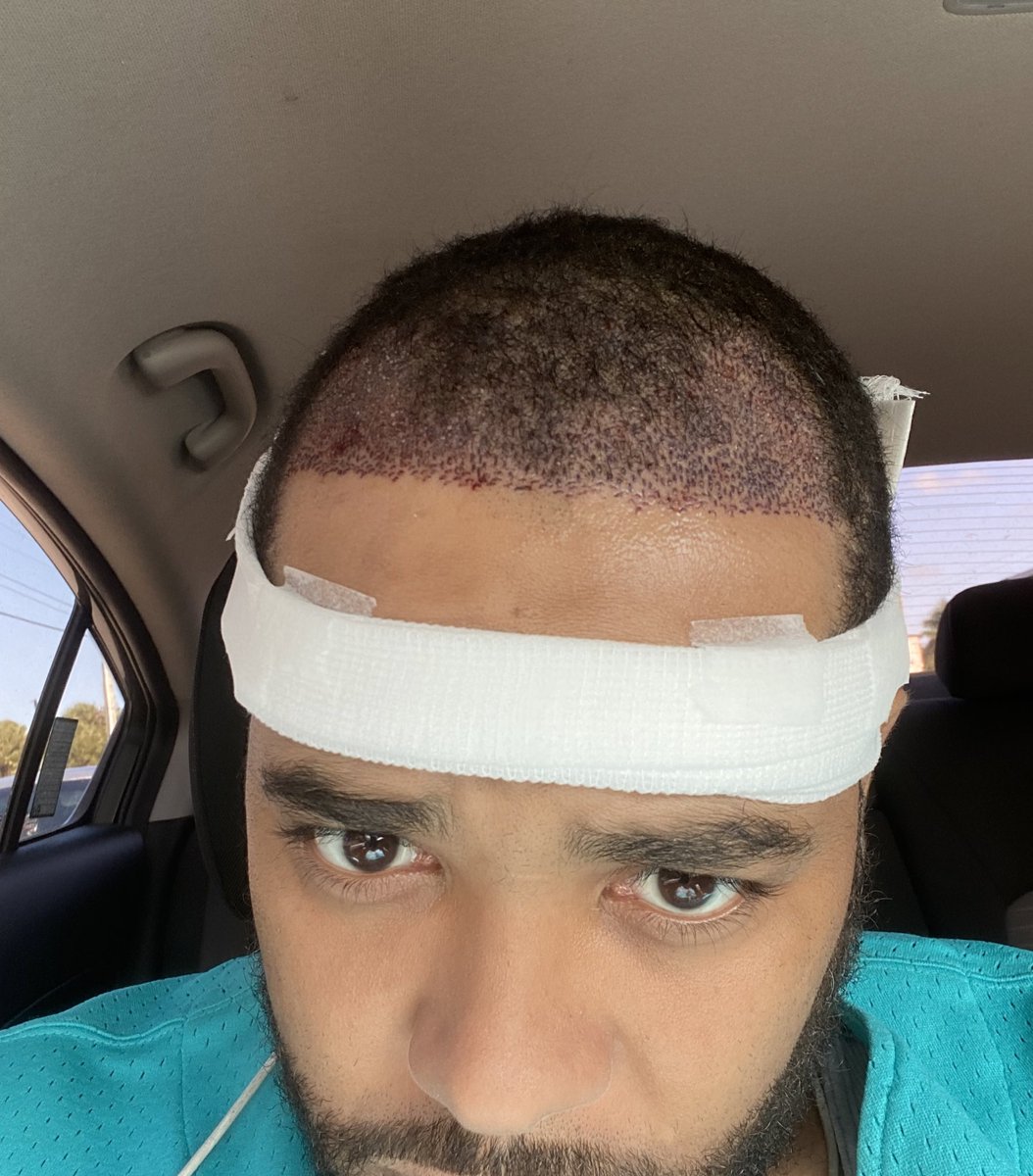 Remember when i said the next 10k i get im buyin a new hairline! Get ya money up not ya funny up😏