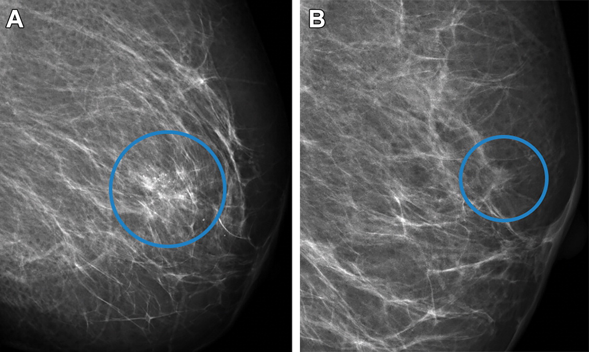 Radiology (@radiology_rsna) on Twitter photo AI-based screening was able to detect normal, moderate-risk, and suspicious mammograms in a breast cancer screening program, which may reduce the radiologist workload. <a href="/andefader/">Andreas David Lauritzen</a> <a href="/MLSectionUCPH/">Machine Learning Section @UCPH</a> <a href="/screenpointmed/">ScreenPoint Medical</a> <a href="/AiCentreDK/">Pioneer Centre for AI</a> bit.ly/3JQeCMd AI-based screening was able to detect normal, moderate-risk, and suspicious mammograms in a breast cancer screening program, which may reduce the radiologist workload. <a href="/andefader/">Andreas David Lauritzen</a> <a href="/MLSectionUCPH/">Machine Learning Section @UCPH</a> <a href="/screenpointmed/">ScreenPoint Medical</a> <a href="/AiCentreDK/">Pioneer Centre for AI</a> bit.ly/3JQeCMd