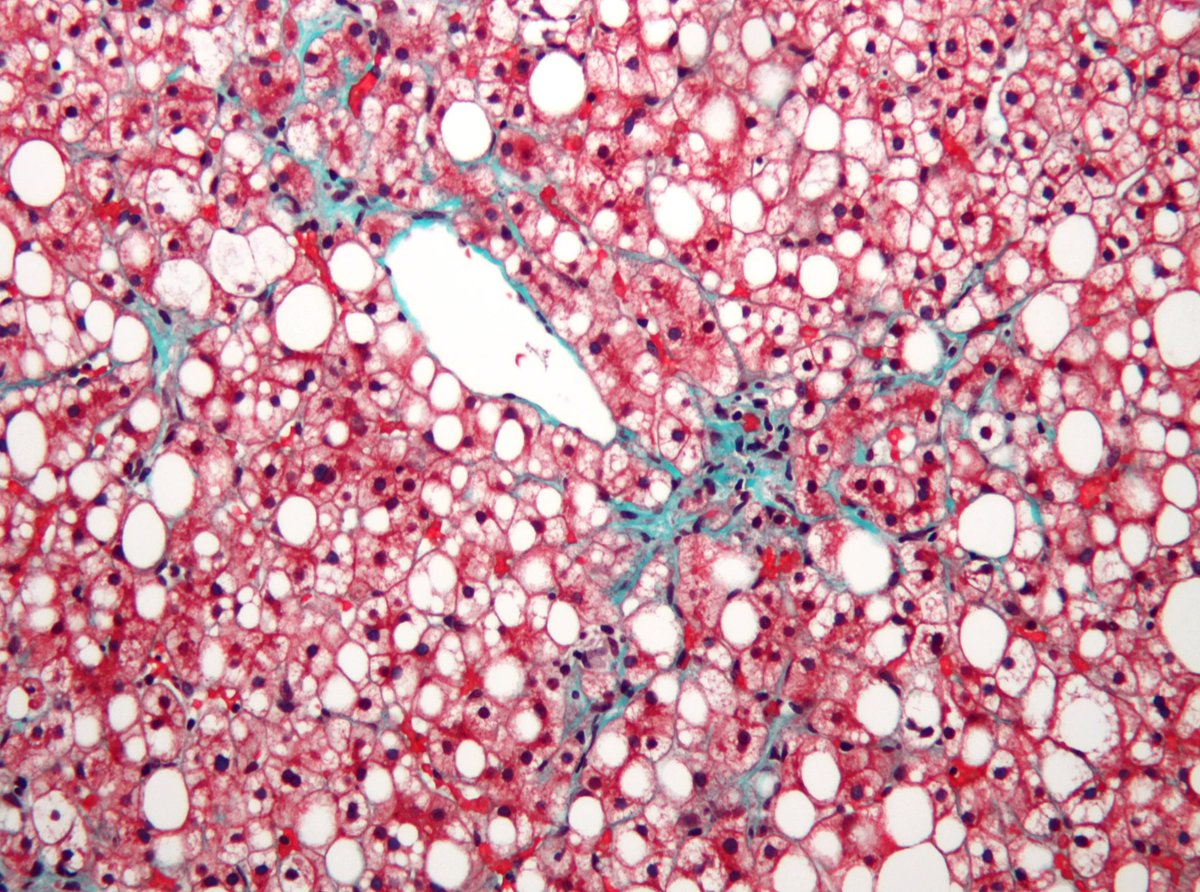 YaleCardiology's tweet photo. Arya Mani, MD, and Henry Ginsberg, MD, of @ColumbiaMed wrote about a fascinating study from the @AranyLab on alternative #mTORC pathway regulation of nonalcoholic fatty liver disease.
Read more in @ScienceMagazine: https://t.co/NxzG6EB4Ab
@YaleMed @YaleCVRC @YaleIMed https://t.co/FIo4kivyYB