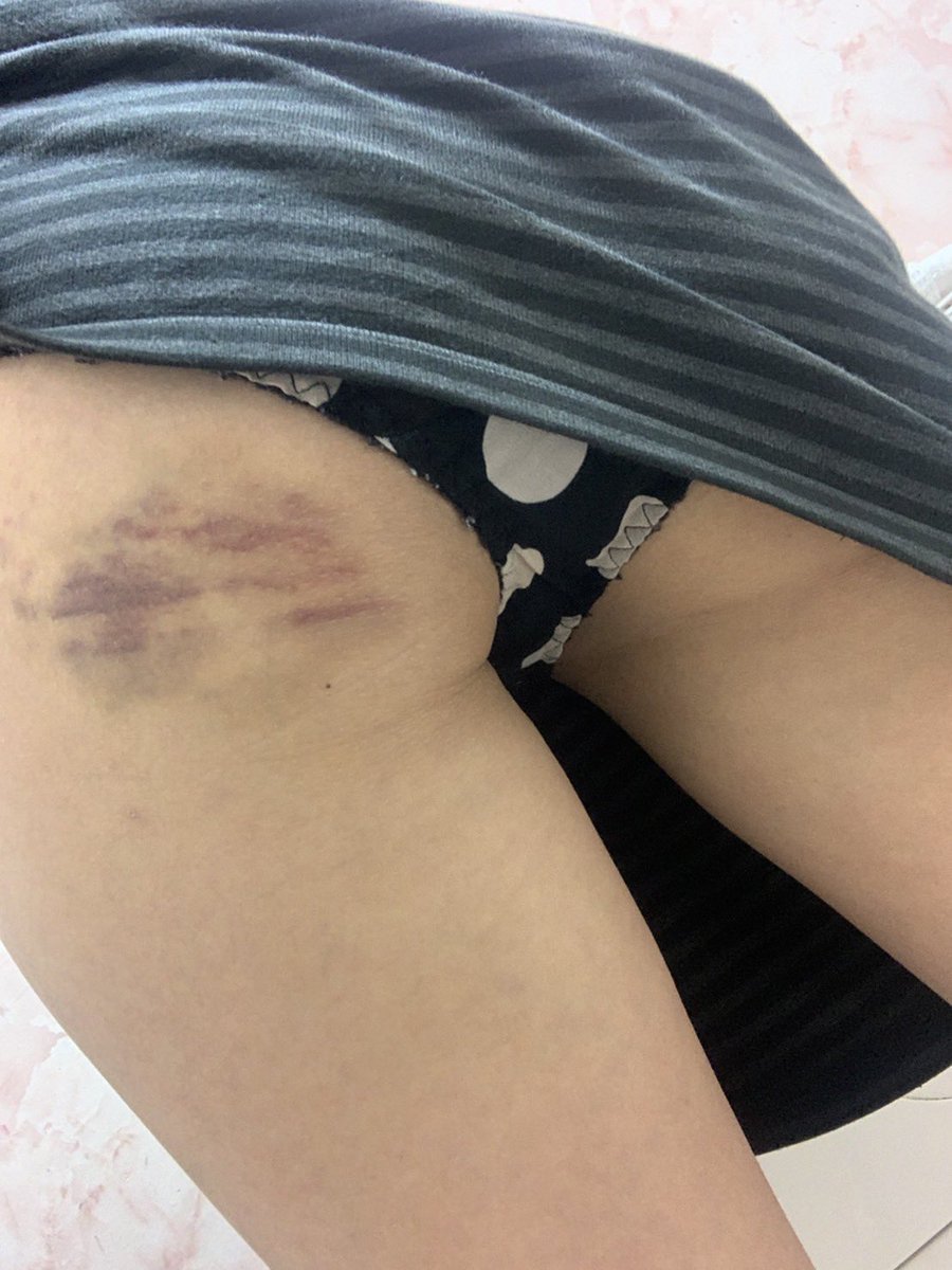 叩き過ぎた(°▽°)