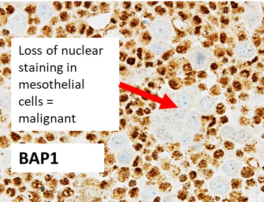 Y C Gary Lee (@ycgarylee) on Twitter photo #PLEURAL_PEARLS_WA 10
<a href="/amber_louw/">Amber Louw</a> (pathologist): When pleural fluid or biopsy samples show mesothelial proliferation, ask your lab for BAP1 & CDKN2A testing. BAP1 loss is present in 60% of mesothelioma (MM) and indicates malignancy. Loss of CDKN2A also indicates MM. #PLEURAL_PEARLS_WA 10
<a href="/amber_louw/">Amber Louw</a> (pathologist): When pleural fluid or biopsy samples show mesothelial proliferation, ask your lab for BAP1 & CDKN2A testing. BAP1 loss is present in 60% of mesothelioma (MM) and indicates malignancy. Loss of CDKN2A also indicates MM.