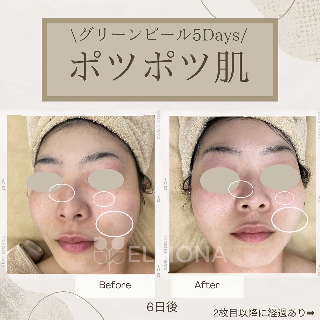 ハーブピーリング グリンピール 松戸newオープン