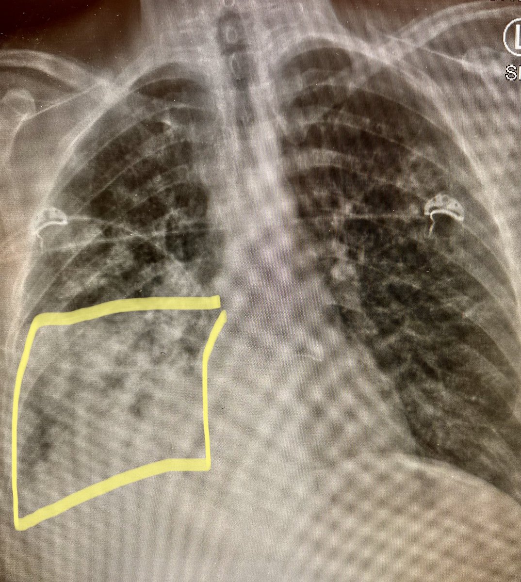 This is an X-ray of a person in their early 30s who is perfectly healthy. They have mild #omicron and severe bacterial pneumonia. (Yellow square). My ICU is full of these cases. Omicron suppresses immunity making people susceptible to severe disease. This makes everyone comorbid.