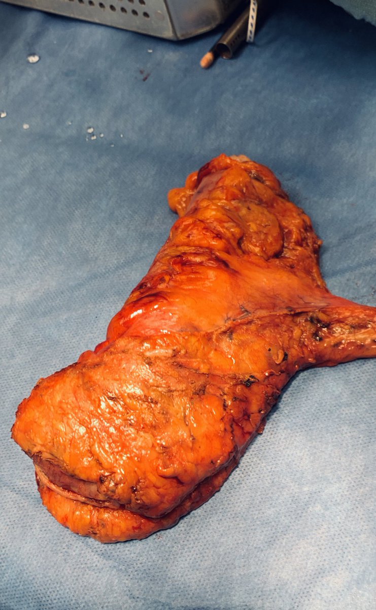 caycedomarula's tweet photo. Same day Robotic LAR on 2 different patients with mid rectal CA. Both underwent short course rads, only one got a diverting ileostomy. Both were discharged on POD 2 (again) ✅Eating, ✅walking, ⬇️⬇️⬇️ pain. Robust #ERAS program @QueensCRS #Some4Surgery 
@epipatelmd https://t.co/9lCwKYtZol