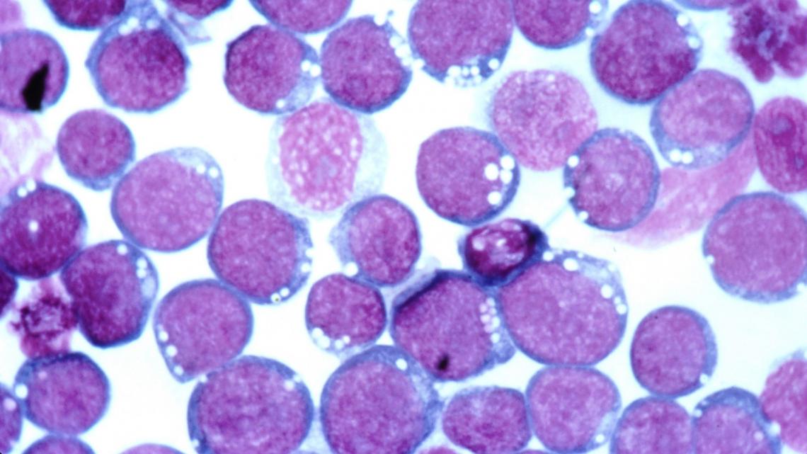 mssocietyuk's tweet photo. A new immunotherapy treatment in a trial for progressive MS hit the headlines recently. News reports say it could reverse or stabilise the progression of MS by targeting the Epstein-Barr virus (EBV). 

We looked behind the headlines to find out more: https://t.co/GT8Ug1GeVO https://t.co/JhDK5OKZUT