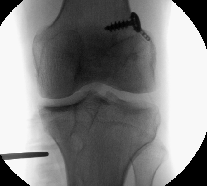 kneedoclond's tweet photo. 3/4.
Per-operative images of commencement and post opening, with hinge wire in place and temporary pinning of osteotomy plate, before bone grafting and secure plate fixation
#patientspecificinstrumentation
#psi https://t.co/TUNZfWdYOV