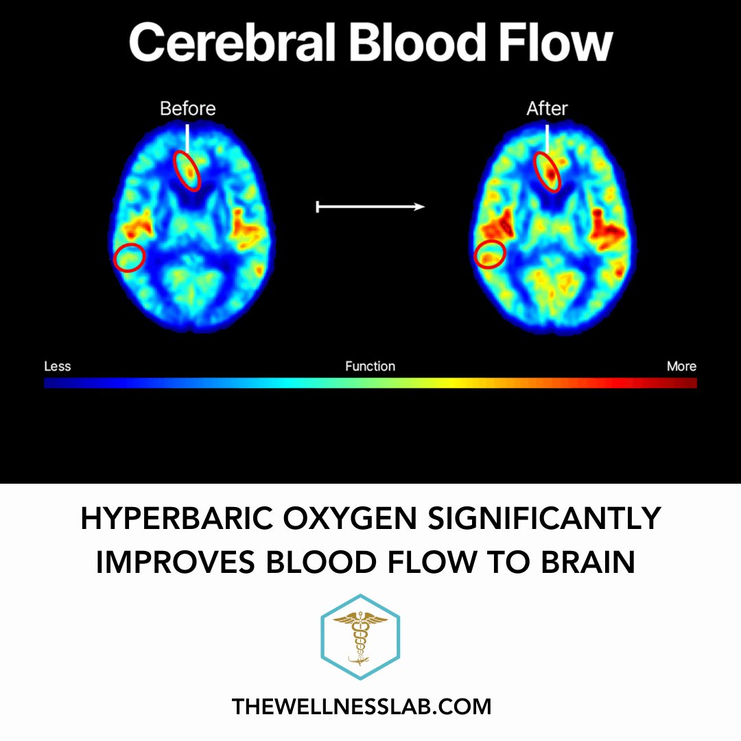 The Wellness Lab - Hyperbaric Oxygen tweet media